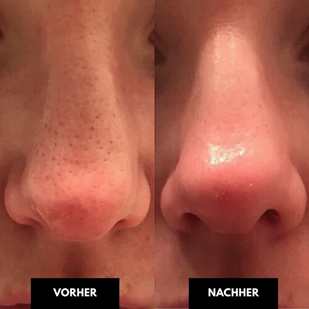 HydroClear - Vakuum Mitesserentferner