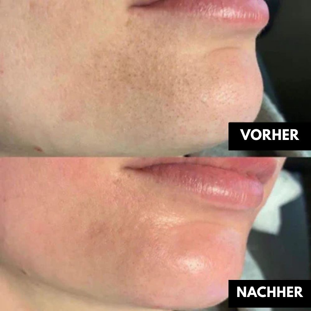 HydroClear - Vakuum Mitesserentferner