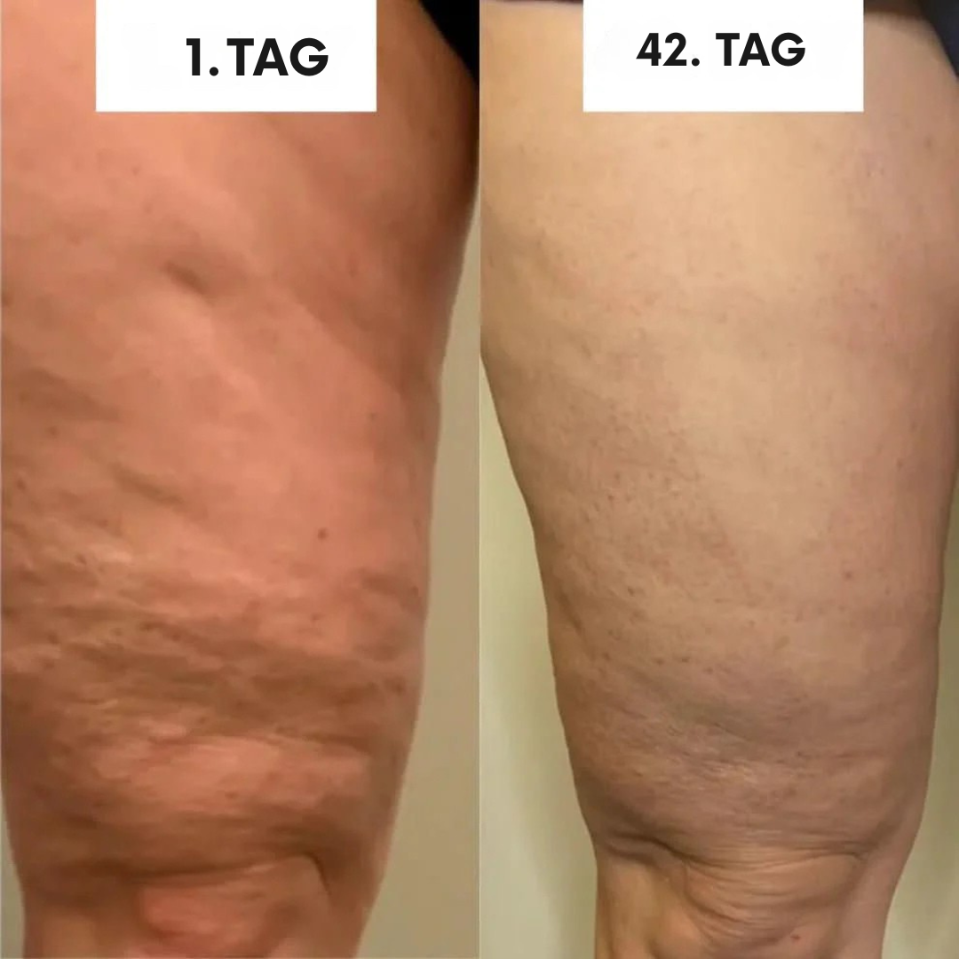 SkinGlow – Anti-Cellulite Massagegerät