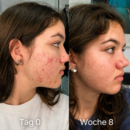 CleraSkin - Akne-Gesichtsmaske mit Rotlicht