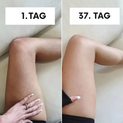 SkinGlow – Anti-Cellulite Massagegerät