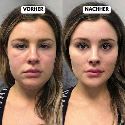 VELURA™ - EMS Face Lifting