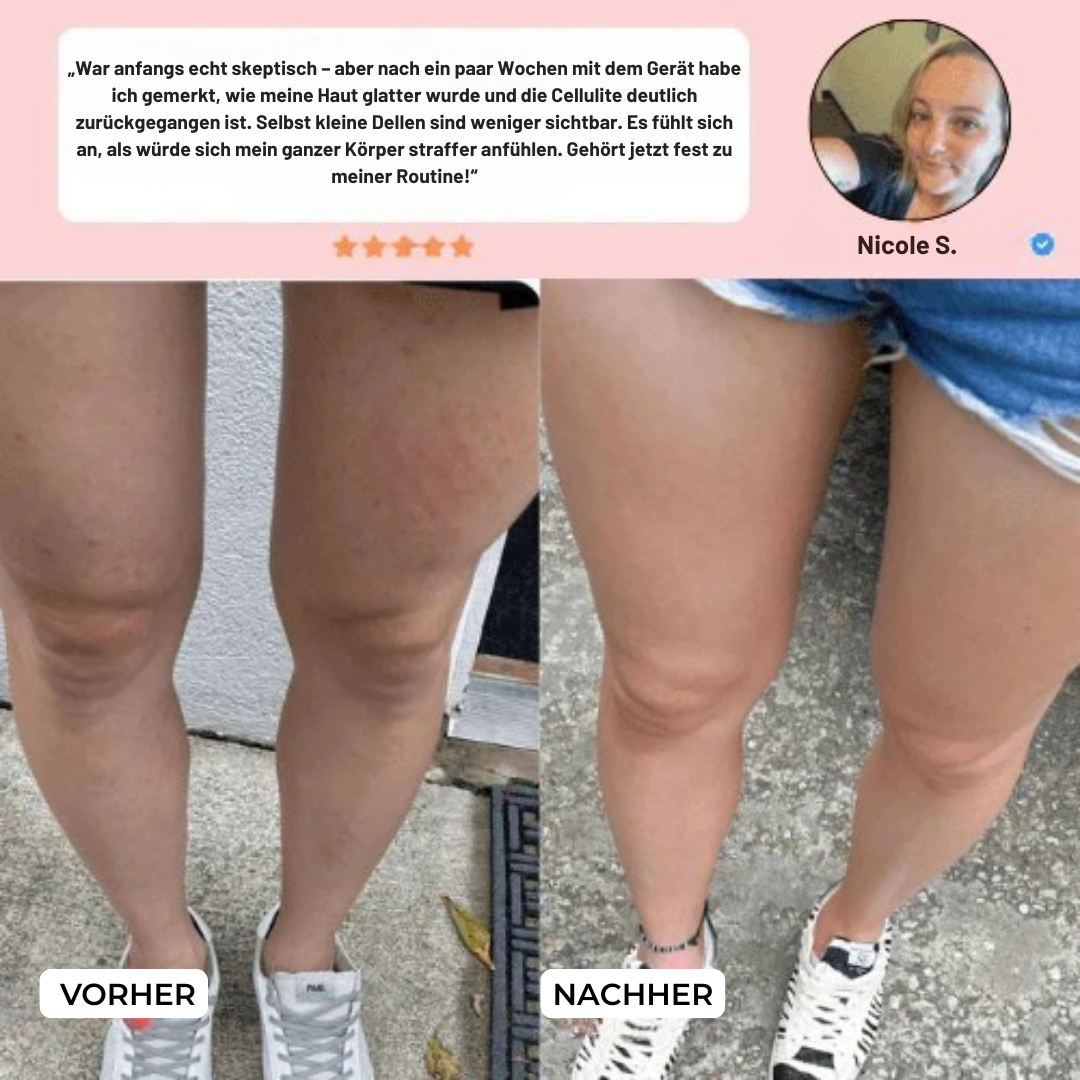 SkinGlow – Anti-Cellulite Massagegerät