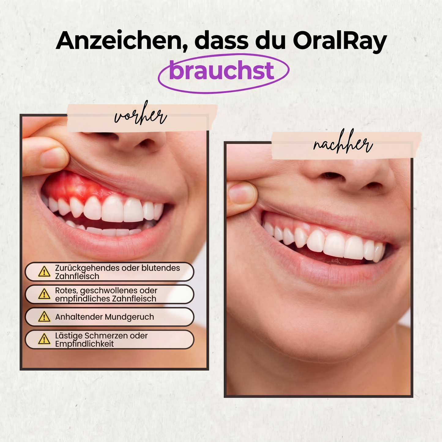 OralRay - Rotlichttherapie gegen Zahnfleischentzündung