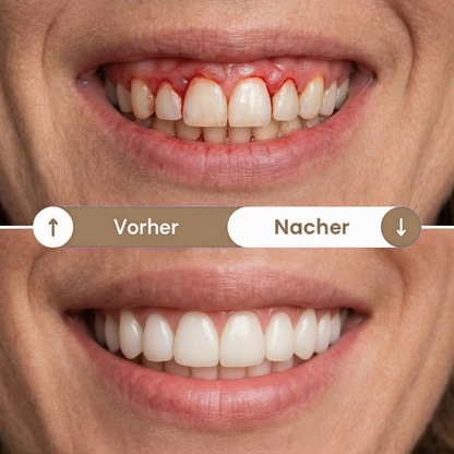 OralRay - Rotlichttherapie gegen Zahnfleischentzündung